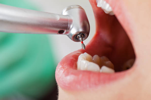 Best Emergency Dental Care for Sports Injuries in Princeton, WV